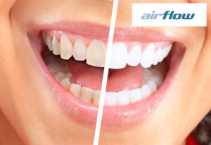 Чистка зубов методом Air flow: преимущества и недостатки