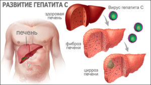 Что представляет собой гепатит C: особенности заболевания и способы лечения